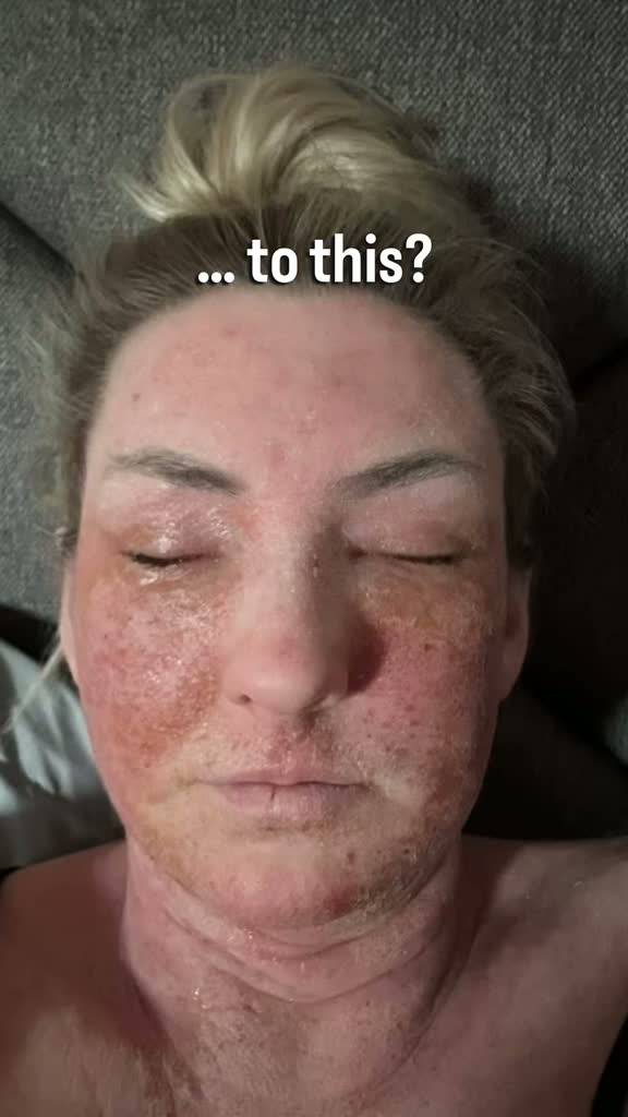 Birmingham Teacher Left 'Looking Like a Burnt Hamster' After Eczema Cream Withdrawal